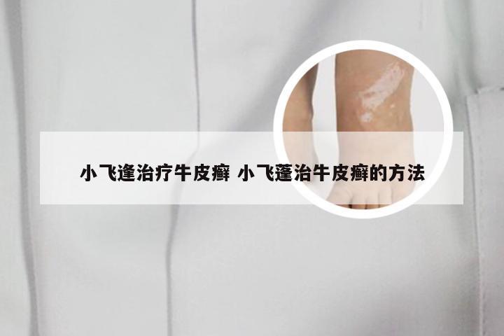 小飞逢治疗牛皮癣 小飞蓬治牛皮癣的方法