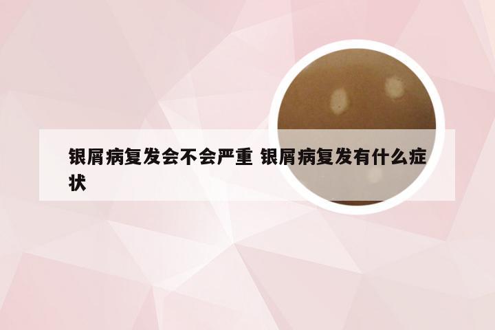 银屑病复发会不会严重 银屑病复发有什么症状