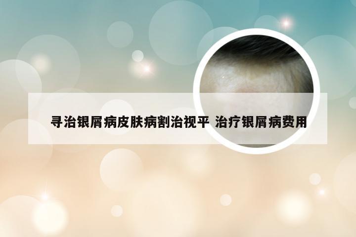 寻治银屑病皮肤病割治视平 治疗银屑病费用