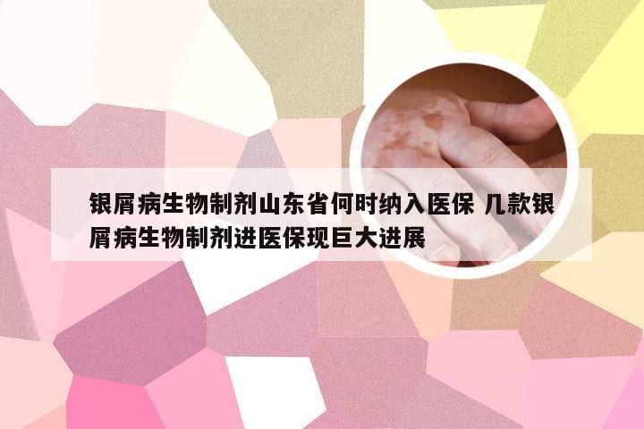 银屑病生物制剂山东省何时纳入医保 几款银屑病生物制剂进医保现巨大进展