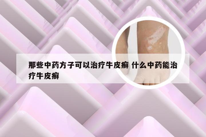 那些中药方子可以治疗牛皮癣 什么中药能治疗牛皮癣