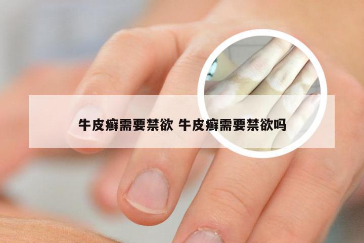 牛皮癣需要禁欲 牛皮癣需要禁欲吗