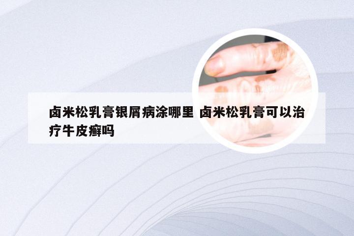 卤米松乳膏银屑病涂哪里 卤米松乳膏可以治疗牛皮癣吗