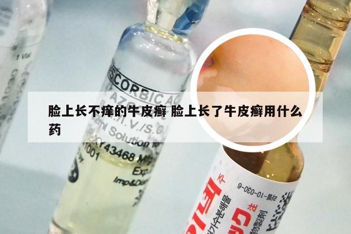 脸上长不痒的牛皮癣 脸上长了牛皮癣用什么药