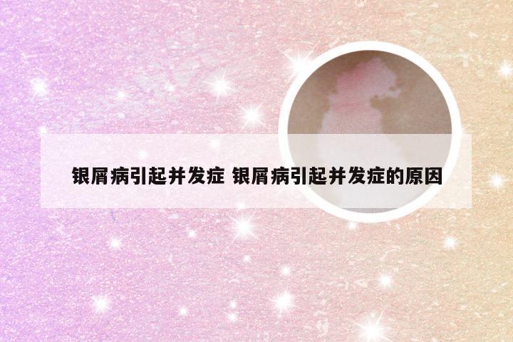 银屑病引起并发症 银屑病引起并发症的原因