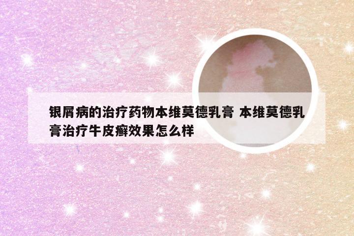 银屑病的治疗药物本维莫德乳膏 本维莫德乳膏治疗牛皮癣效果怎么样