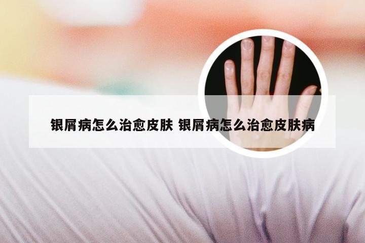 银屑病怎么治愈皮肤 银屑病怎么治愈皮肤病