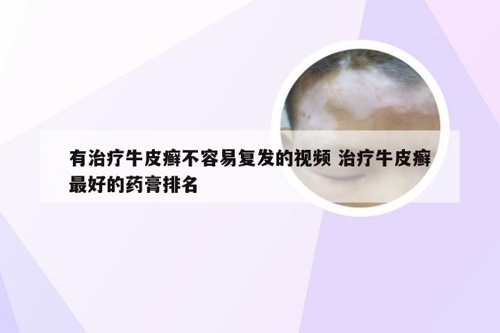 有治疗牛皮癣不容易复发的视频 治疗牛皮癣最好的药膏排名