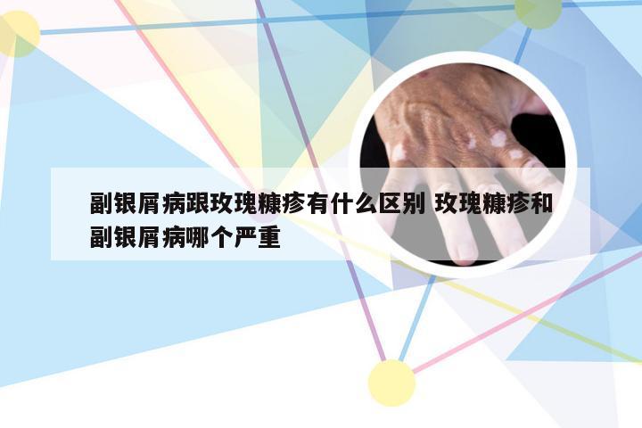 副银屑病跟玫瑰糠疹有什么区别 玫瑰糠疹和副银屑病哪个严重