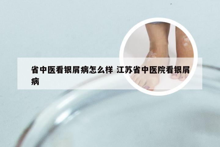 省中医看银屑病怎么样 江苏省中医院看银屑病
