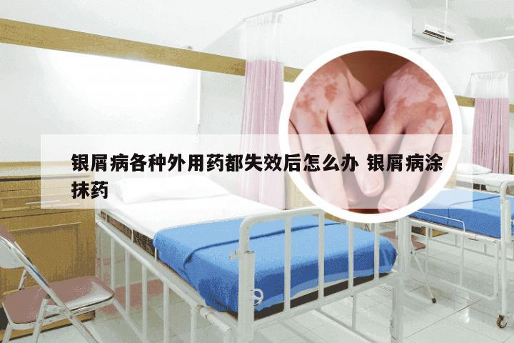 银屑病各种外用药都失效后怎么办 银屑病涂抹药