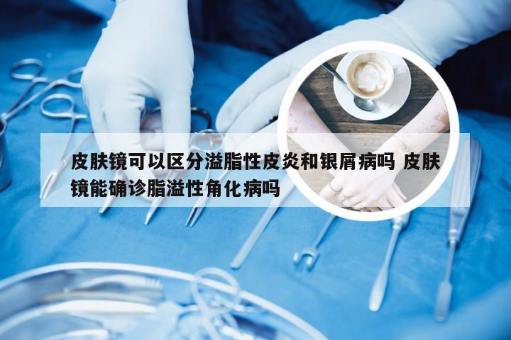 皮肤镜可以区分溢脂性皮炎和银屑病吗 皮肤镜能确诊脂溢性角化病吗