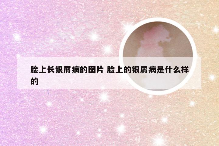 脸上长银屑病的图片 脸上的银屑病是什么样的