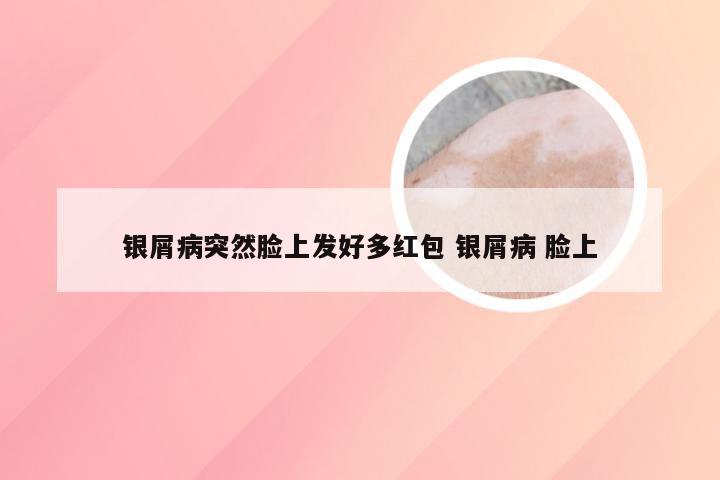 银屑病突然脸上发好多红包 银屑病 脸上