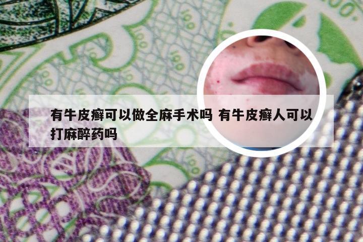 有牛皮癣可以做全麻手术吗 有牛皮癣人可以打麻醉药吗