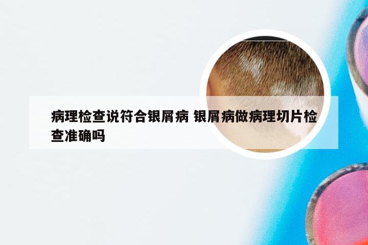 病理检查说符合银屑病 银屑病做病理切片检查准确吗