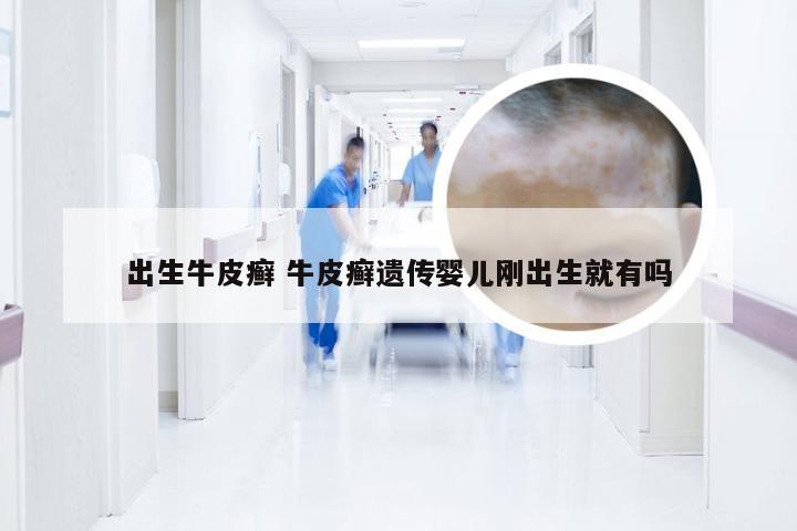出生牛皮癣 牛皮癣遗传婴儿刚出生就有吗