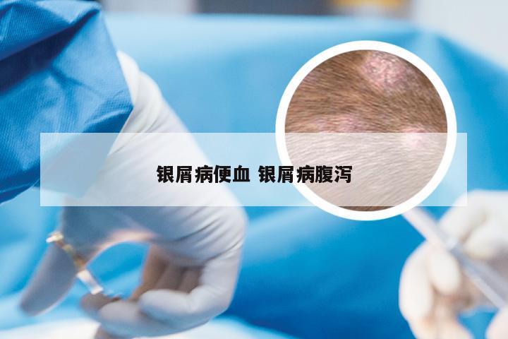 银屑病便血 银屑病腹泻