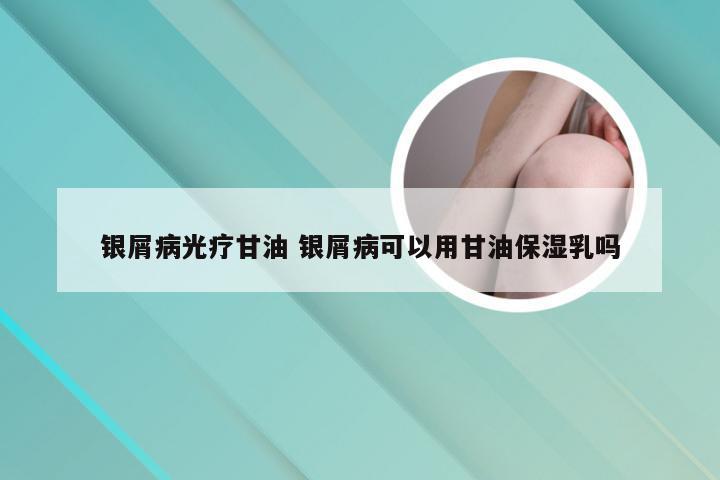 银屑病光疗甘油 银屑病可以用甘油保湿乳吗
