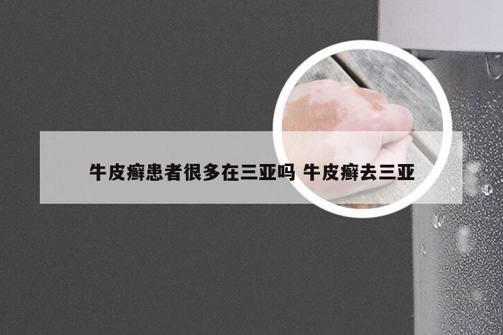牛皮癣患者很多在三亚吗 牛皮癣去三亚
