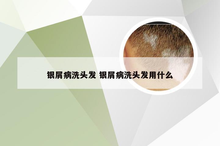 银屑病洗头发 银屑病洗头发用什么