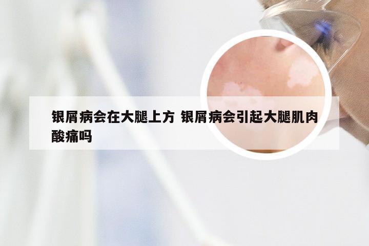 银屑病会在大腿上方 银屑病会引起大腿肌肉酸痛吗