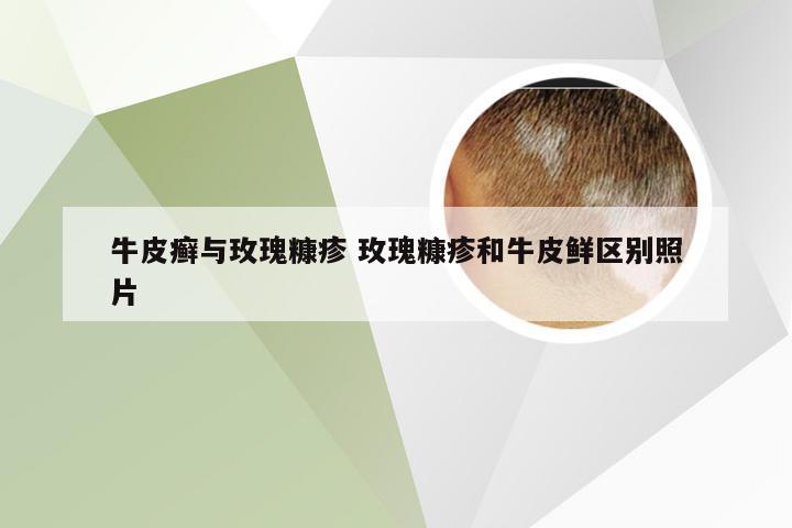 牛皮癣与玫瑰糠疹 玫瑰糠疹和牛皮鲜区别照片