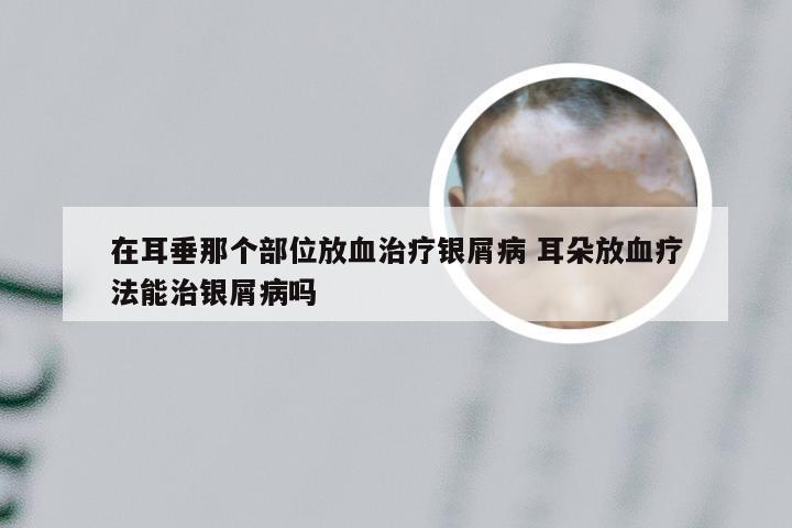 在耳垂那个部位放血治疗银屑病 耳朵放血疗法能治银屑病吗