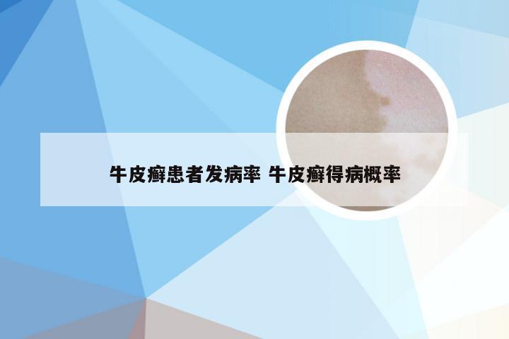 牛皮癣患者发病率 牛皮癣得病概率
