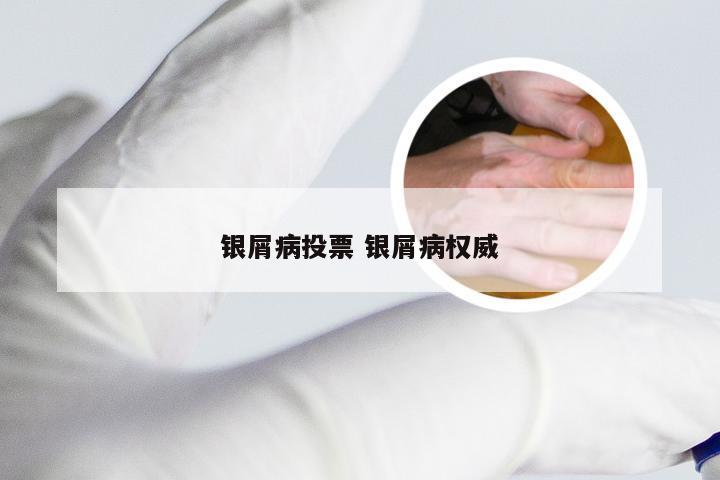 银屑病投票 银屑病权威