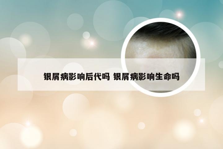 银屑病影响后代吗 银屑病影响生命吗