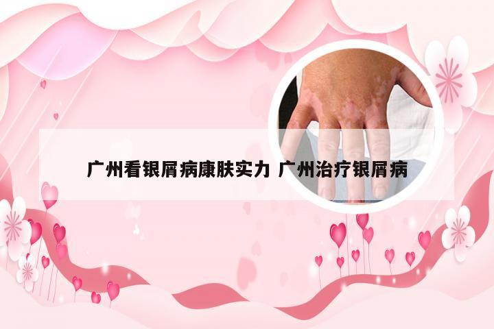 广州看银屑病康肤实力 广州治疗银屑病