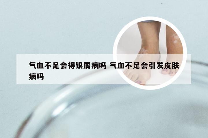 气血不足会得银屑病吗 气血不足会引发皮肤病吗