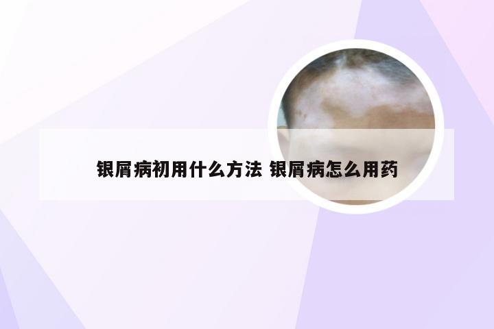 银屑病初用什么方法 银屑病怎么用药