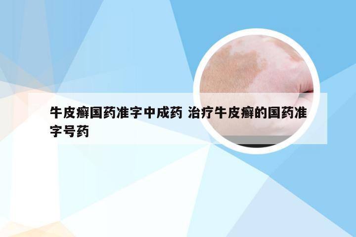 牛皮癣国药准字中成药 治疗牛皮癣的国药准字号药