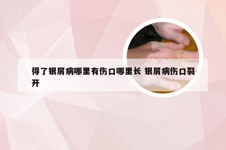 得了银屑病哪里有伤口哪里长 银屑病伤口裂开