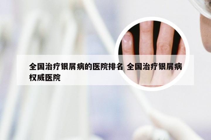 全国治疗银屑病的医院排名 全国治疗银屑病权威医院