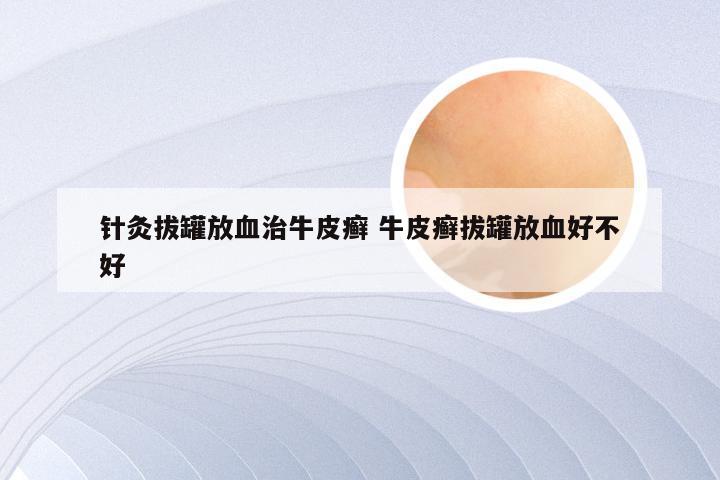 针灸拔罐放血治牛皮癣 牛皮癣拔罐放血好不好