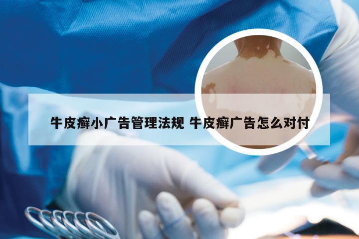牛皮癣小广告管理法规 牛皮癣广告怎么对付