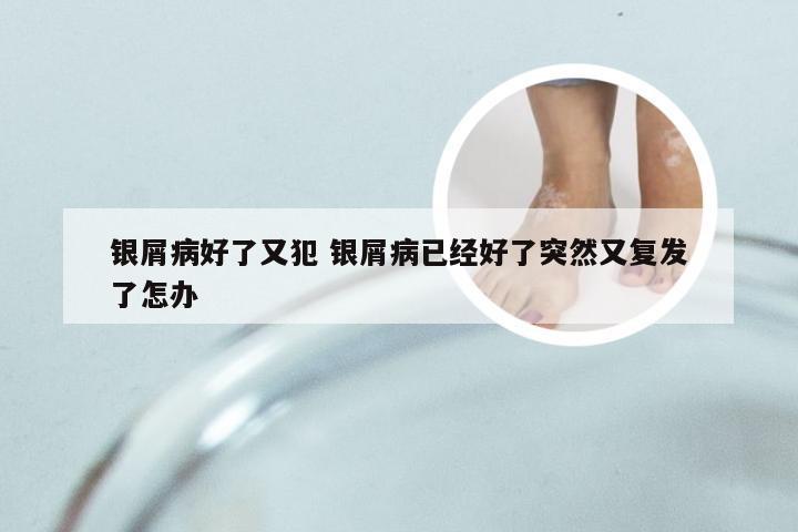 银屑病好了又犯 银屑病已经好了突然又复发了怎办