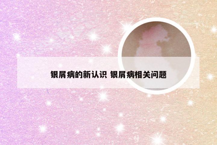 银屑病的新认识 银屑病相关问题