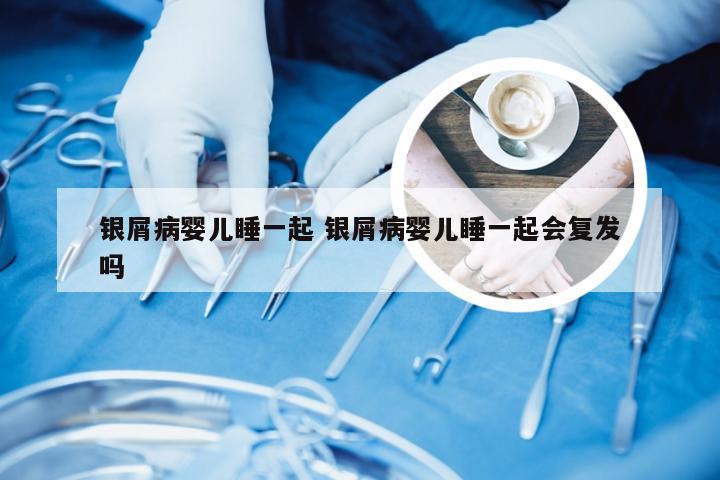 银屑病婴儿睡一起 银屑病婴儿睡一起会复发吗