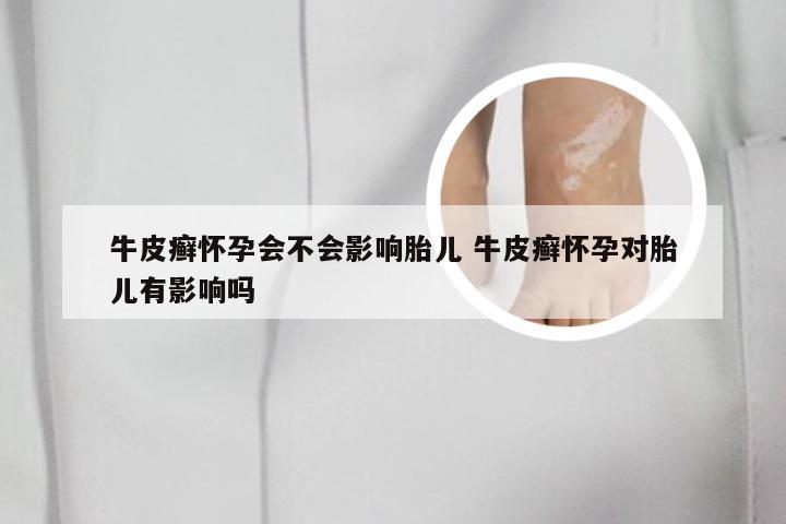 牛皮癣怀孕会不会影响胎儿 牛皮癣怀孕对胎儿有影响吗