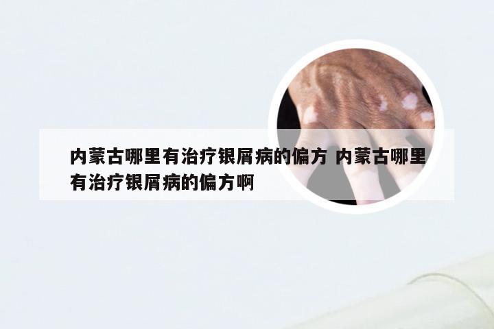 内蒙古哪里有治疗银屑病的偏方 内蒙古哪里有治疗银屑病的偏方啊