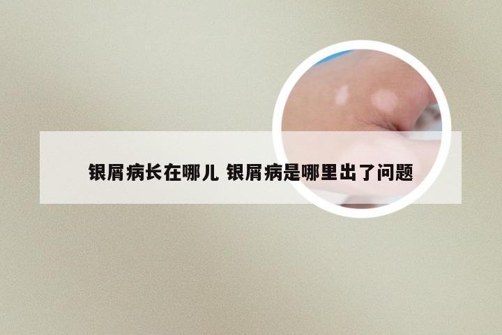 银屑病长在哪儿 银屑病是哪里出了问题