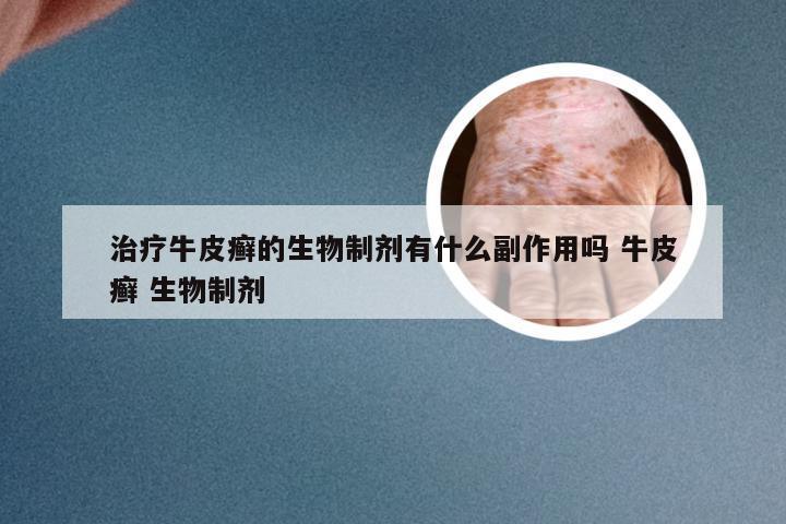 治疗牛皮癣的生物制剂有什么副作用吗 牛皮癣 生物制剂