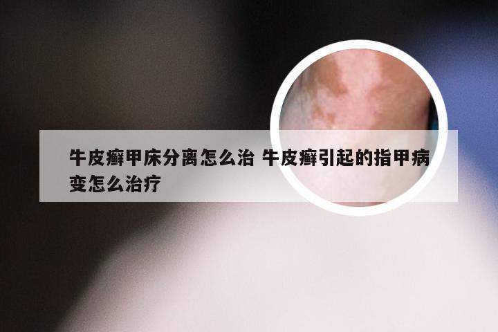 牛皮癣甲床分离怎么治 牛皮癣引起的指甲病变怎么治疗