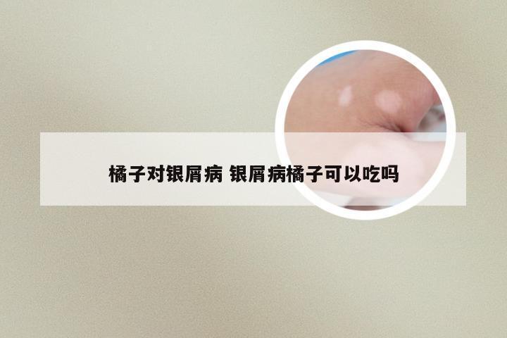 橘子对银屑病 银屑病橘子可以吃吗