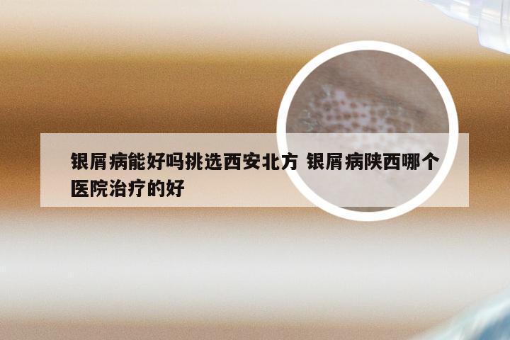 银屑病能好吗挑选西安北方 银屑病陕西哪个医院治疗的好