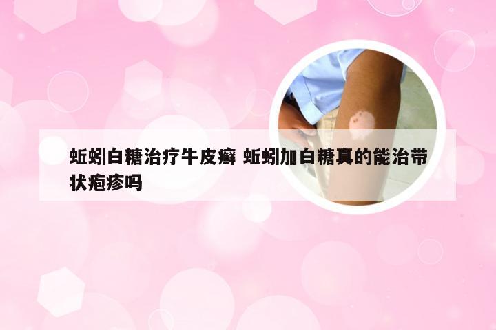 蚯蚓白糖治疗牛皮癣 蚯蚓加白糖真的能治带状疱疹吗